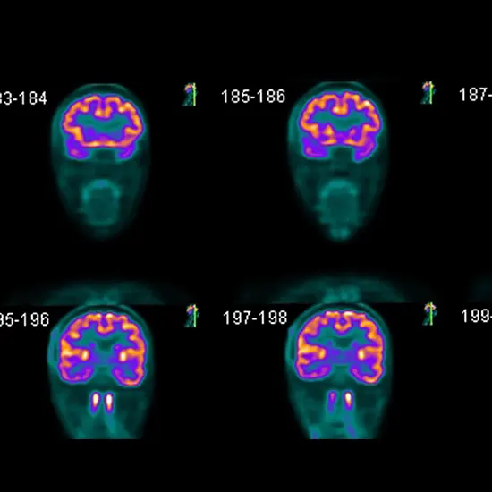 What Is The Procedure Of Brain PET Scan?